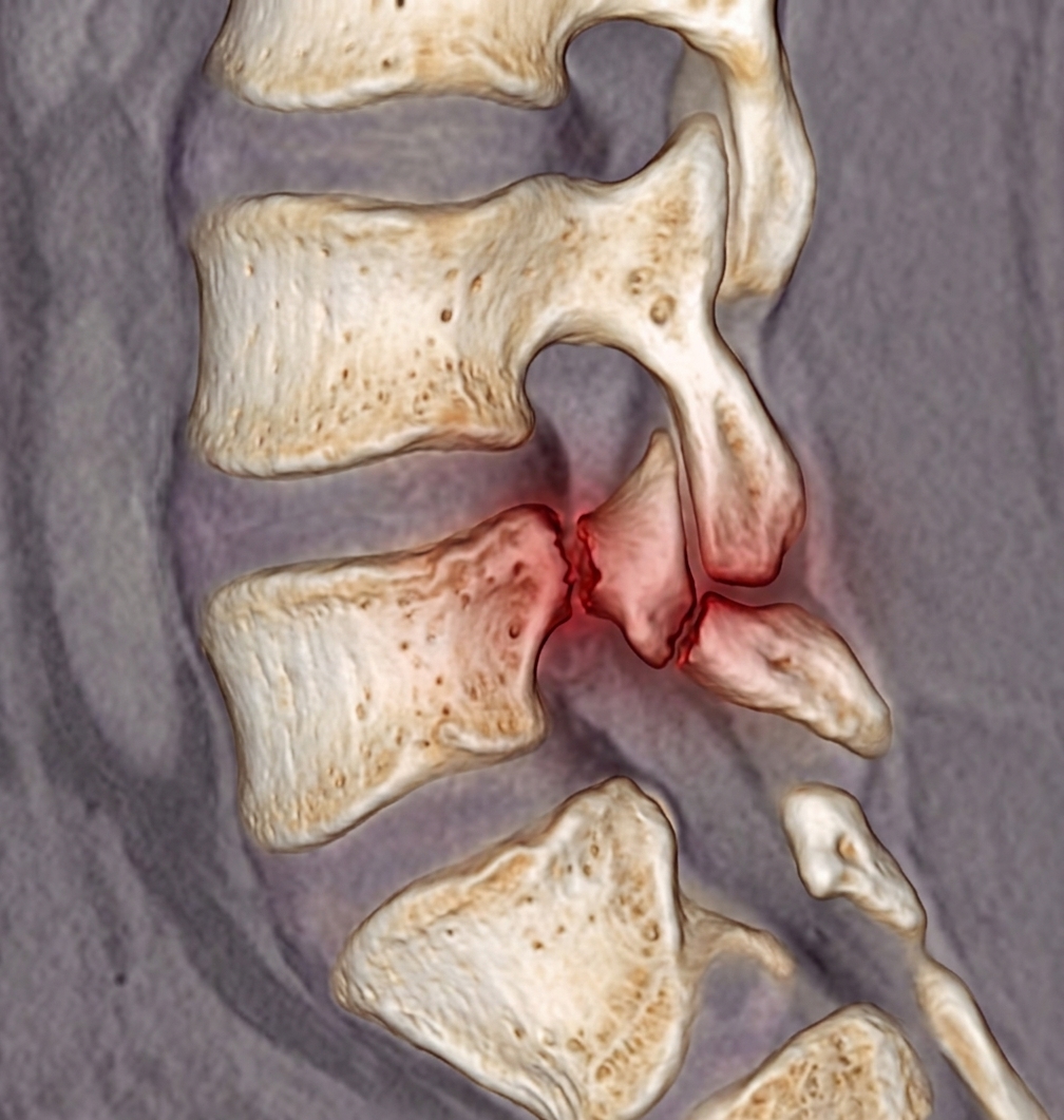 Spondylolysis (pars fracture) – sports spine injury