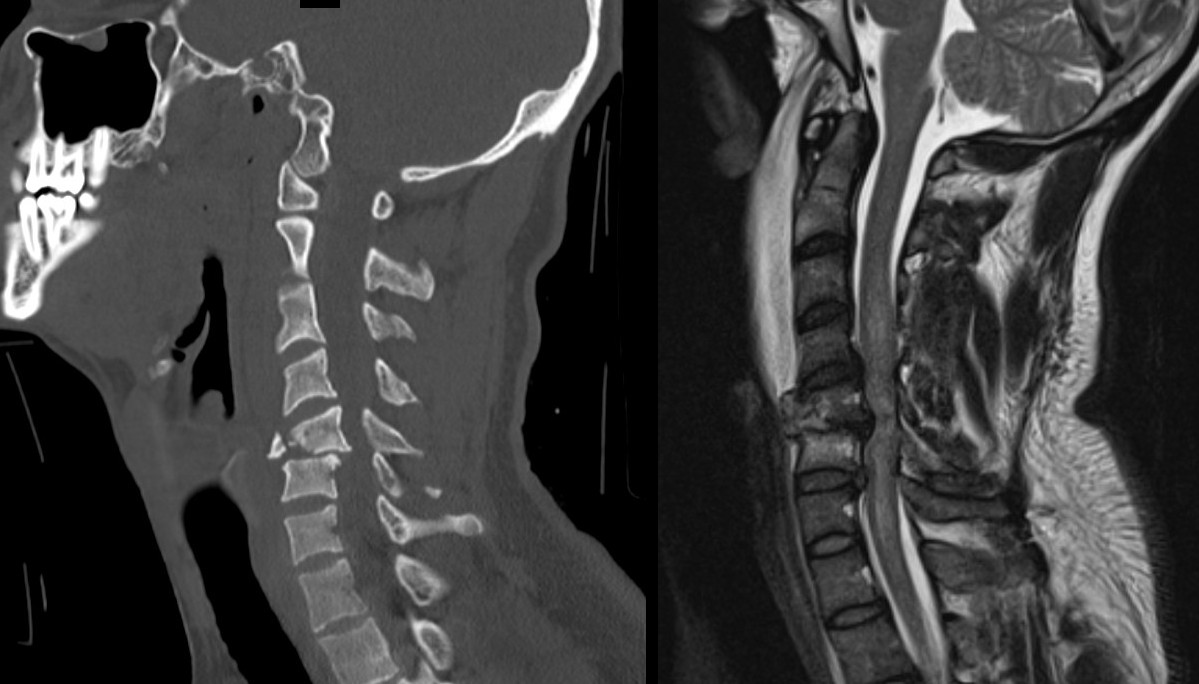 Side CT and MRI of the neck showing a C5/6 fracture-dislocation with the spinal cord compressed