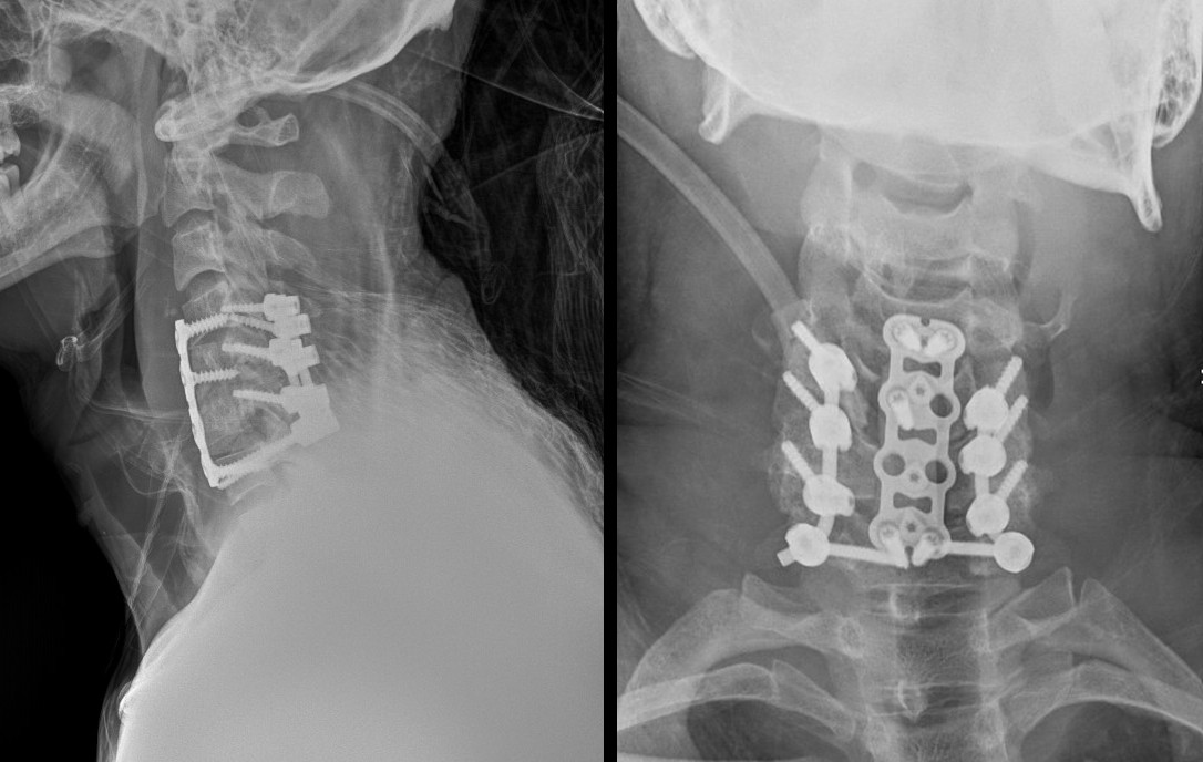 Side and front X-rays after combined front and back surgery with a plate, cage, screws and rods