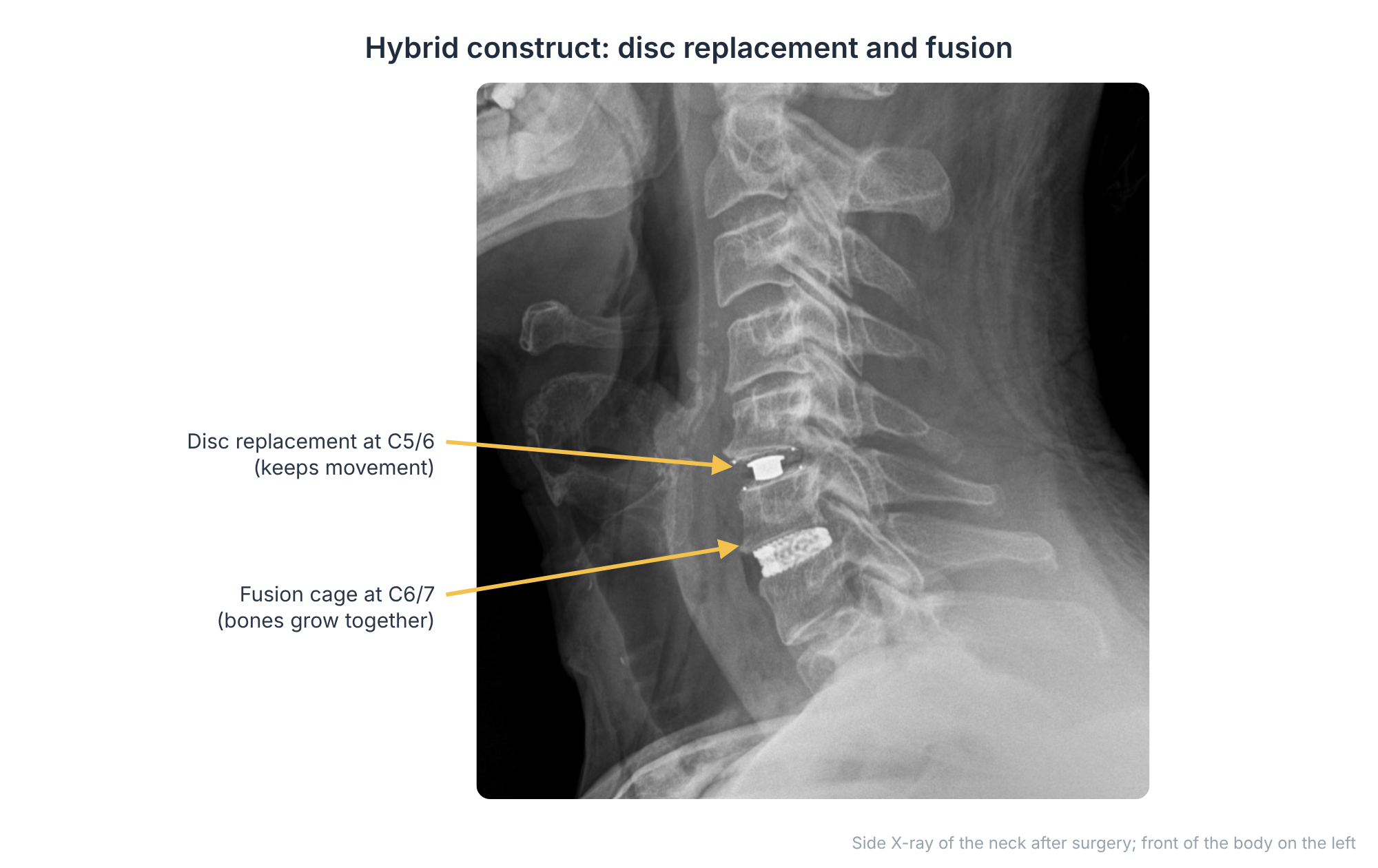 Side X-ray of the neck after a hybrid operation, with a disc replacement at C5/6 and a fusion cage at C6/7