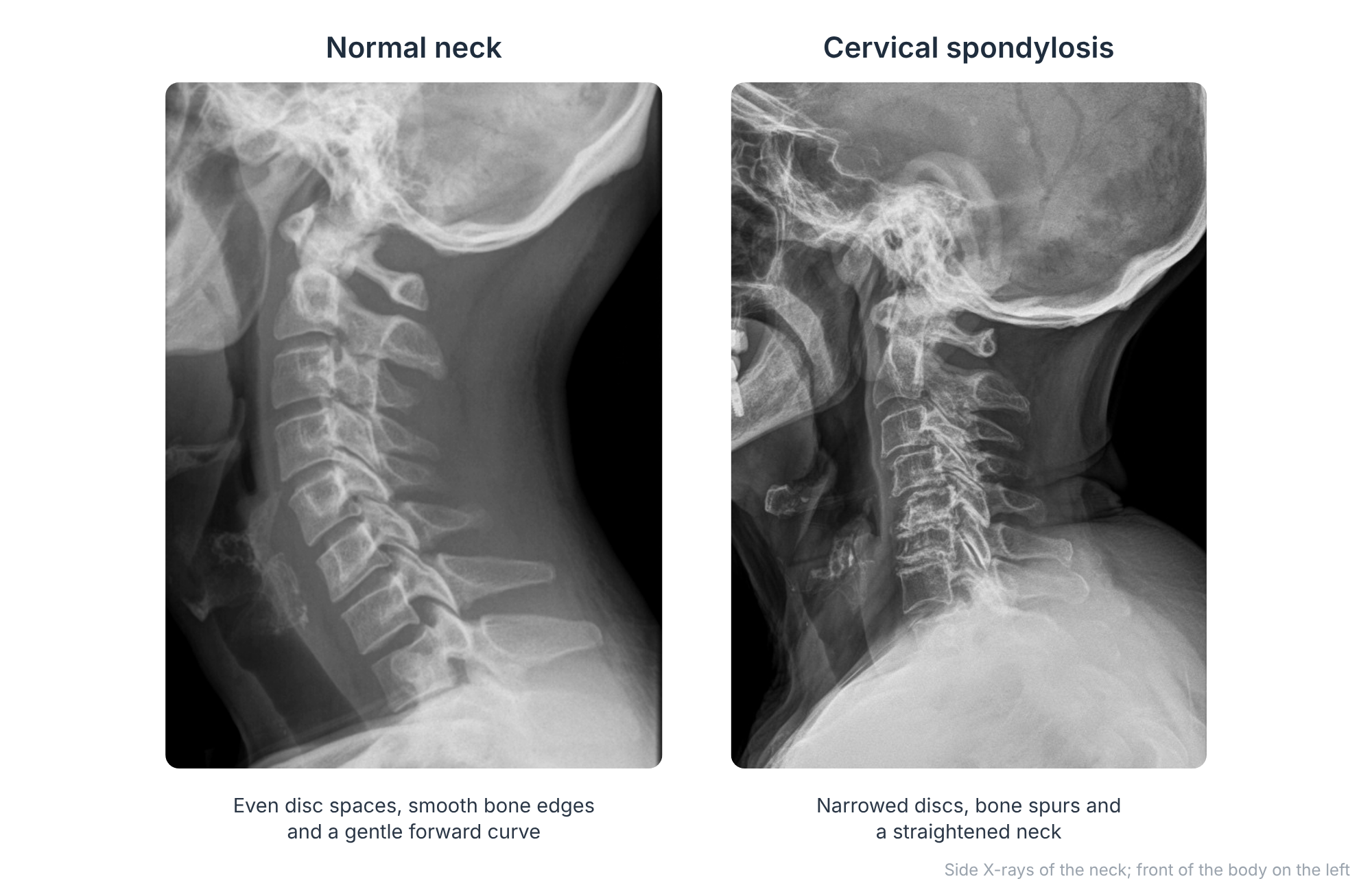 Side X-rays comparing a normal neck with a degenerate neck showing narrowed discs, bone spurs and loss of the normal curve