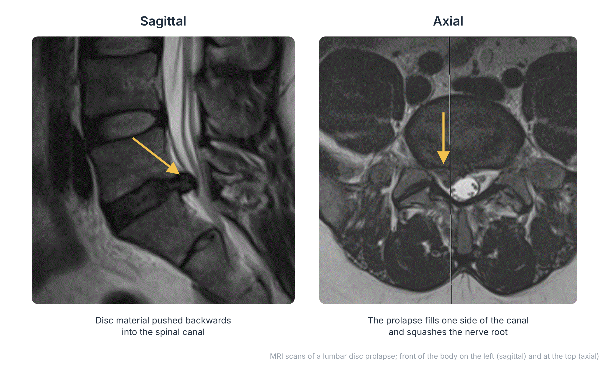 MRI scans of a lumbar disc prolapse on sagittal and axial views, with arrows showing disc material pressing into the spinal canal