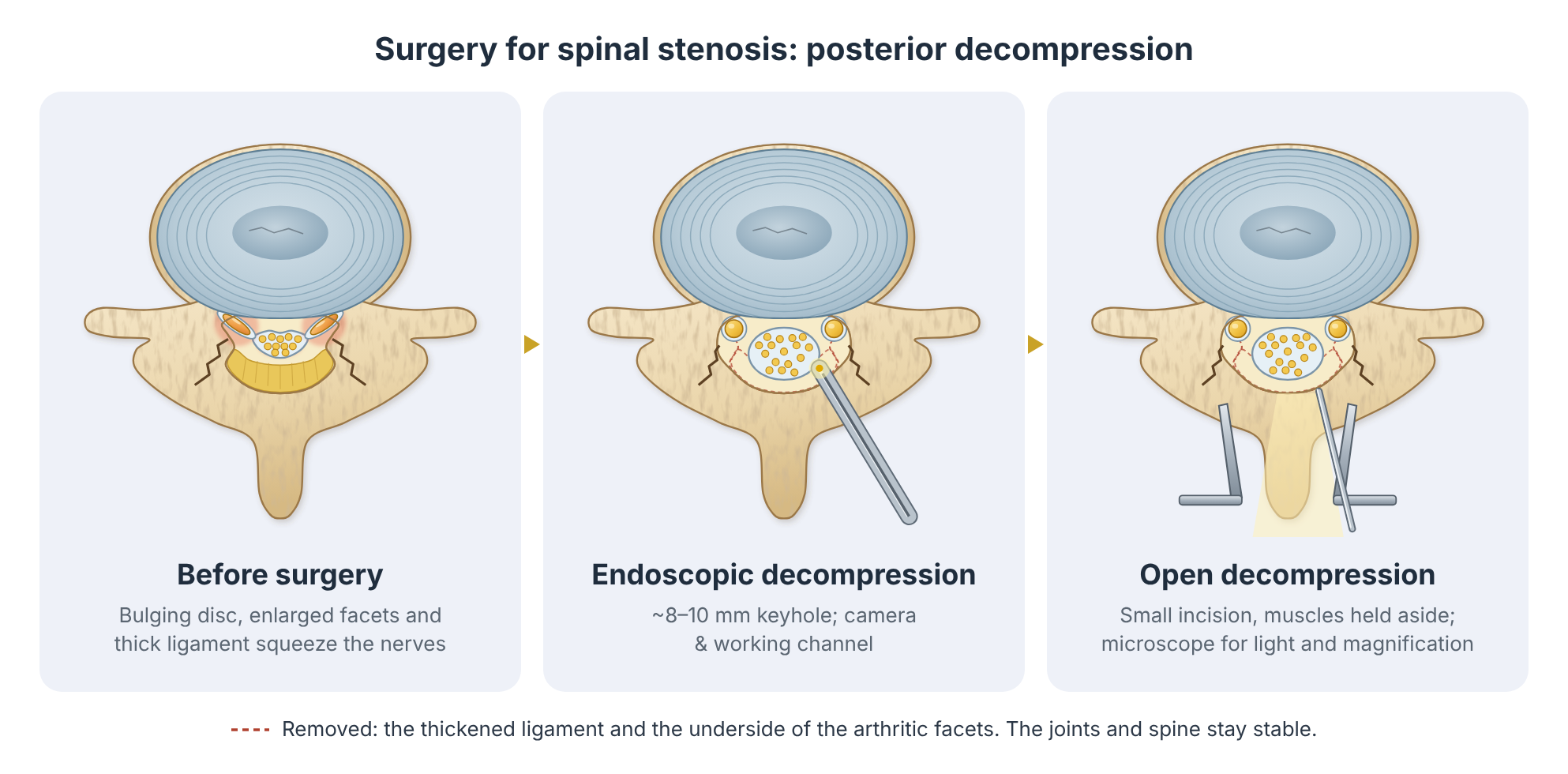 Before and after posterior decompression for lumbar spinal stenosis, done endoscopically or as an open operation