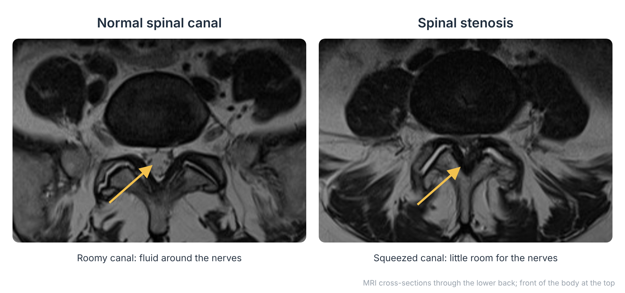 MRI scans through the lower back comparing a normal, roomy spinal canal with a narrowed canal in spinal stenosis