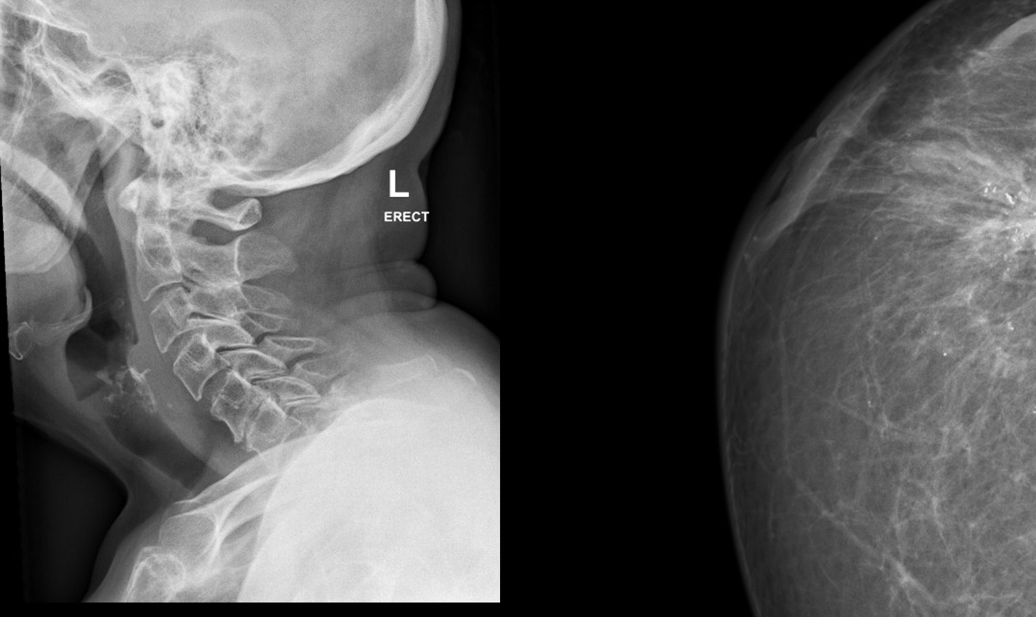 Side X-ray of the neck and a mammogram from a patient with a history of breast cancer