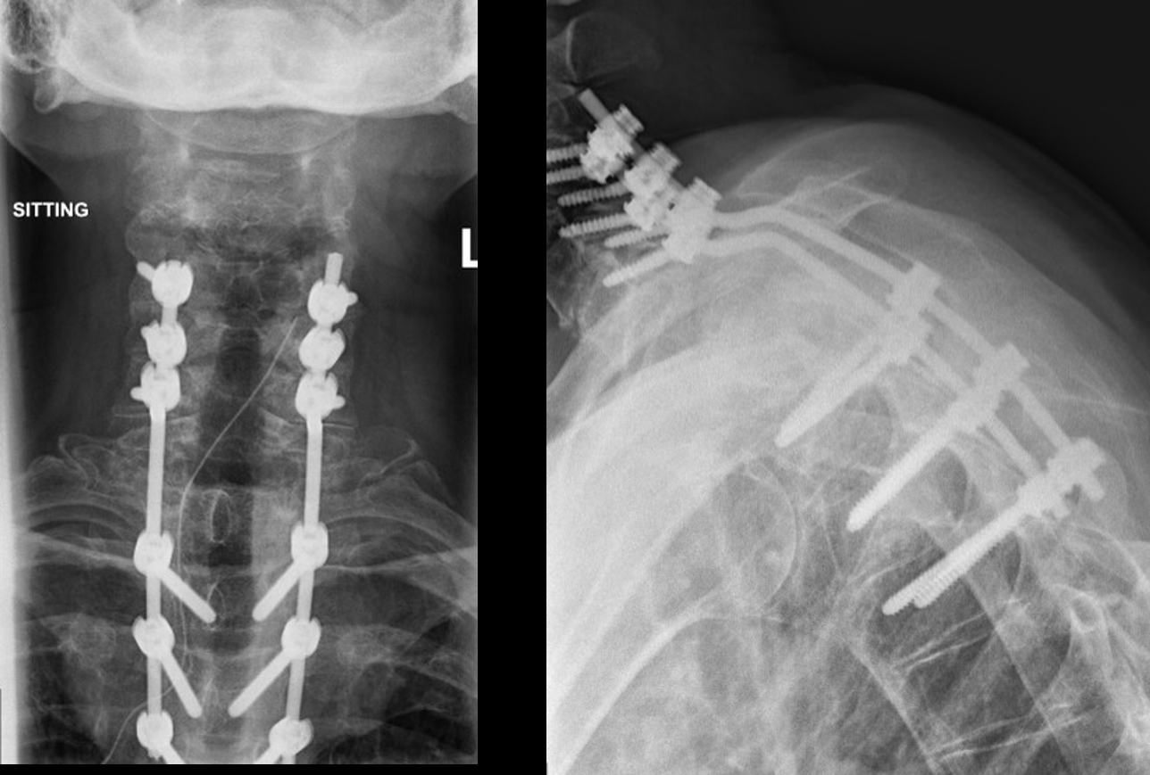 Front and side X-rays after posterior fixation with screws and rods from the neck to the upper back