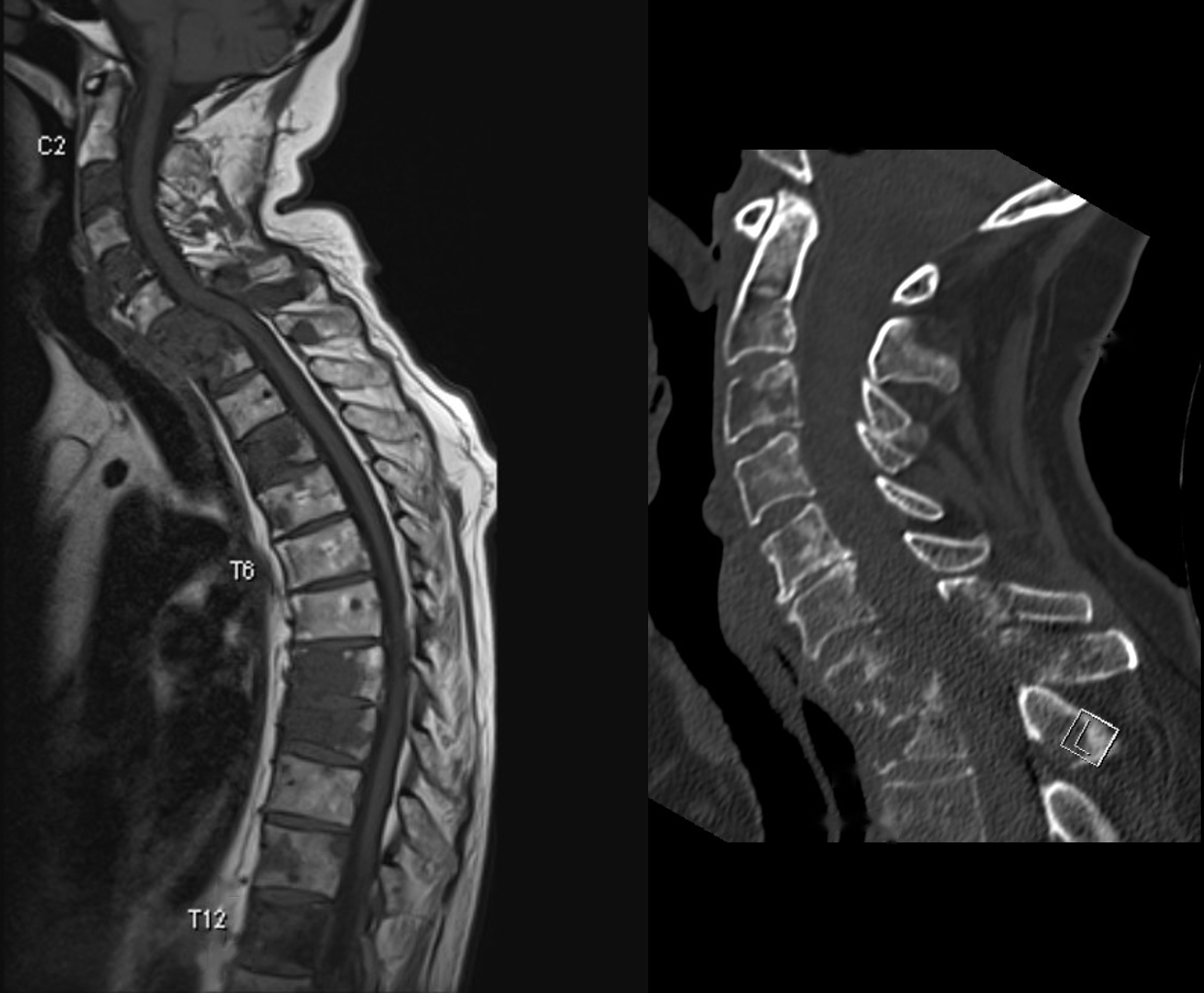Side MRI of the cervical and thoracic spine and side CT of the neck showing multiple vertebrae destroyed by metastases