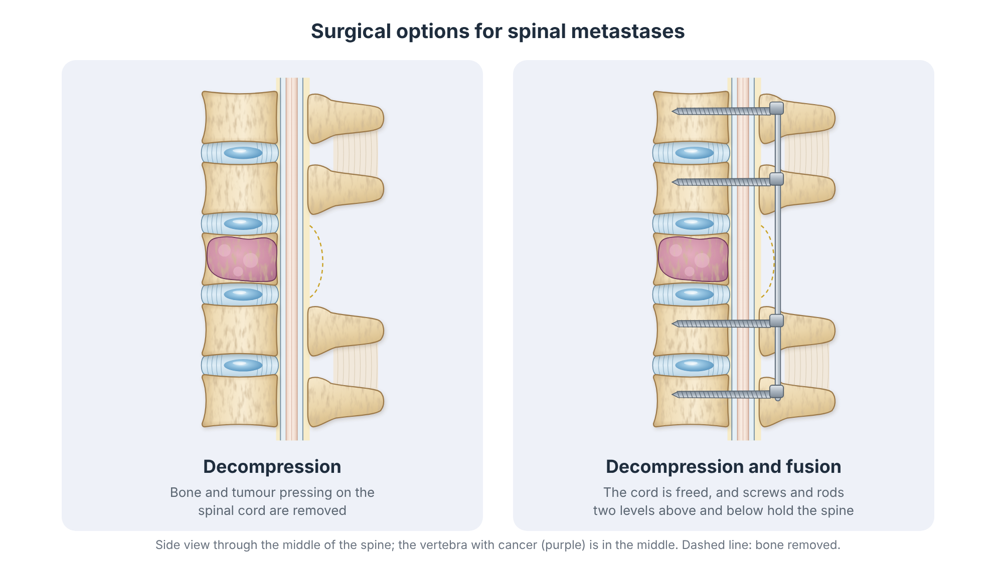 Side views of the spine showing two operations for spinal metastases: decompression, and decompression with fusion using screws and rods two levels above and below