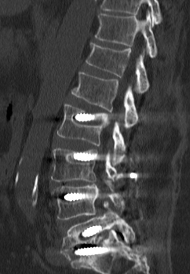 Side CT scan of the lumbar spine after fusion surgery with screws at several levels, in a patient with a deep surgical site infection