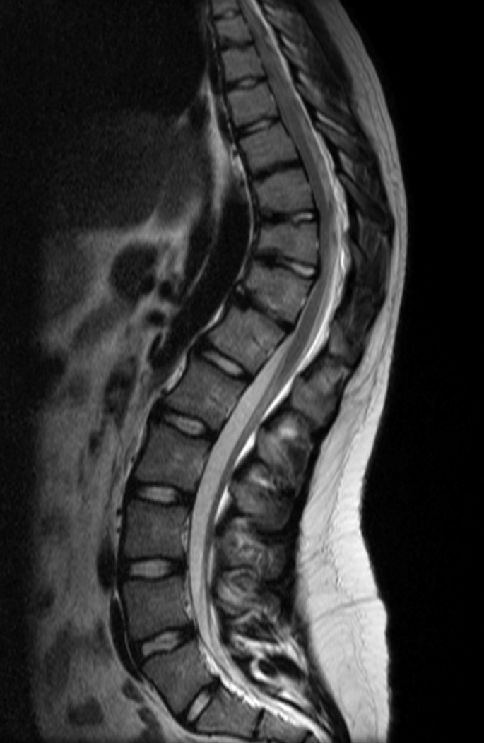 Side MRI of the spine in Scheuermann's kyphosis showing three or more consecutive wedge-shaped vertebrae
