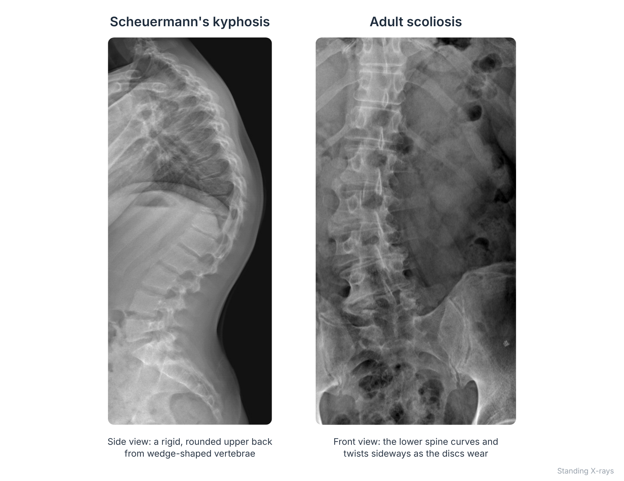 Standing X-rays showing Scheuermann's kyphosis from the side and adult scoliosis from the front