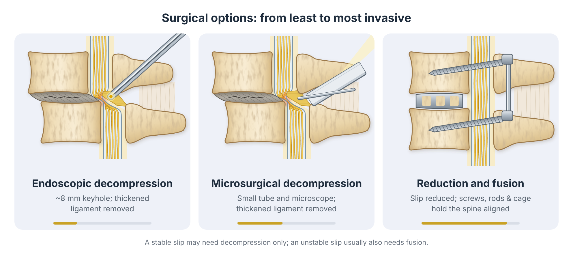 Surgical options for spondylolisthesis: endoscopic decompression, microsurgical decompression, and reduction with fusion