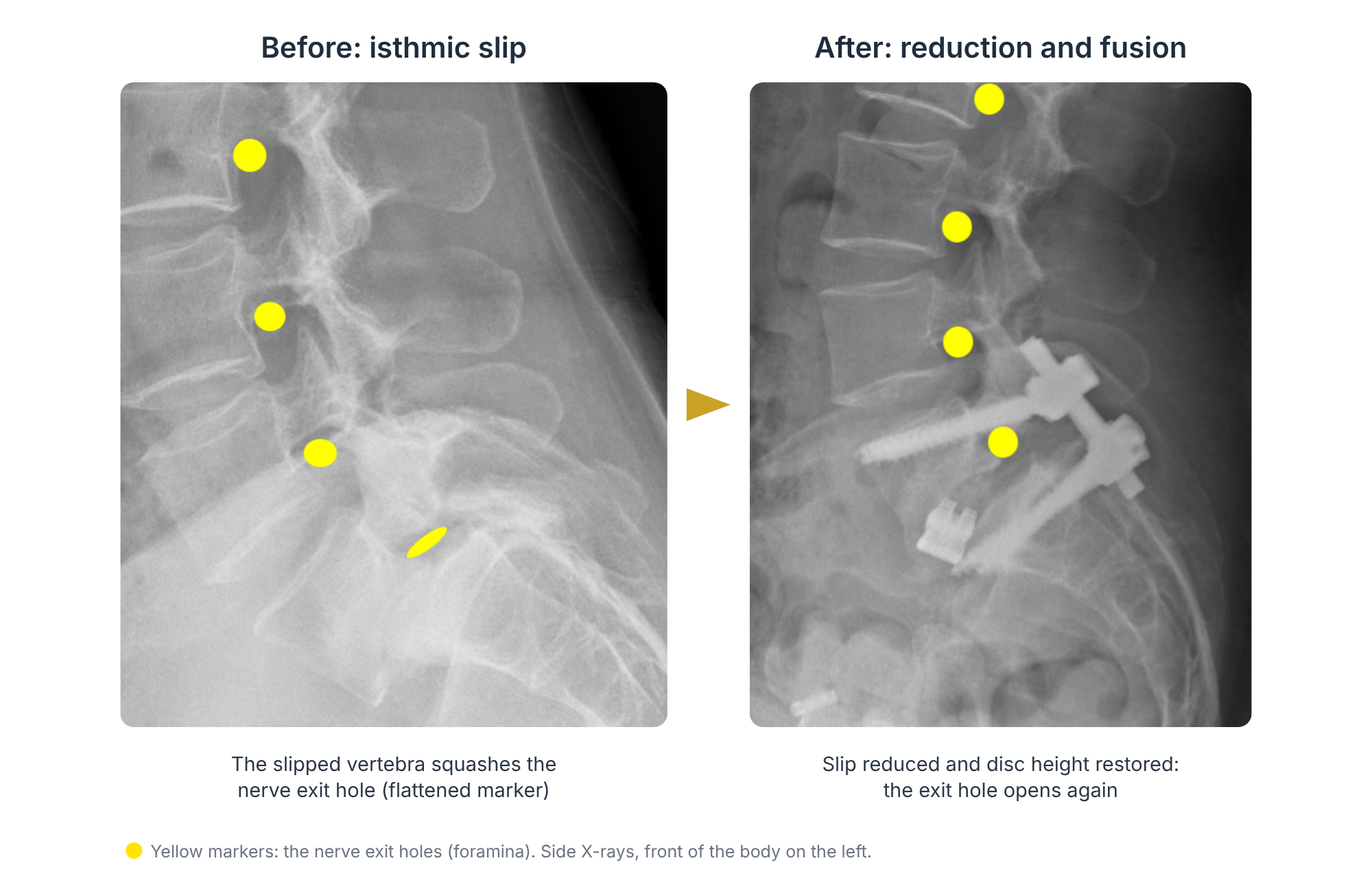 Side X-rays before and after reduction and fusion of an isthmic spondylolisthesis, showing the nerve exit hole squashed before surgery and opened after