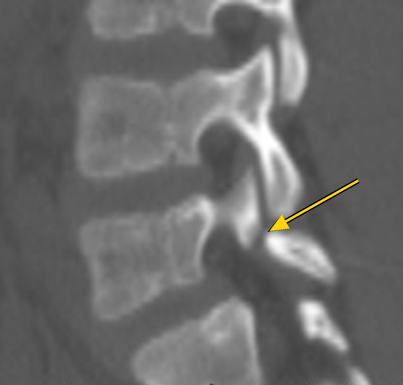 Side CT scan of the lower lumbar spine with an arrow pointing to a gap through the pars of L5 (spondylolysis)