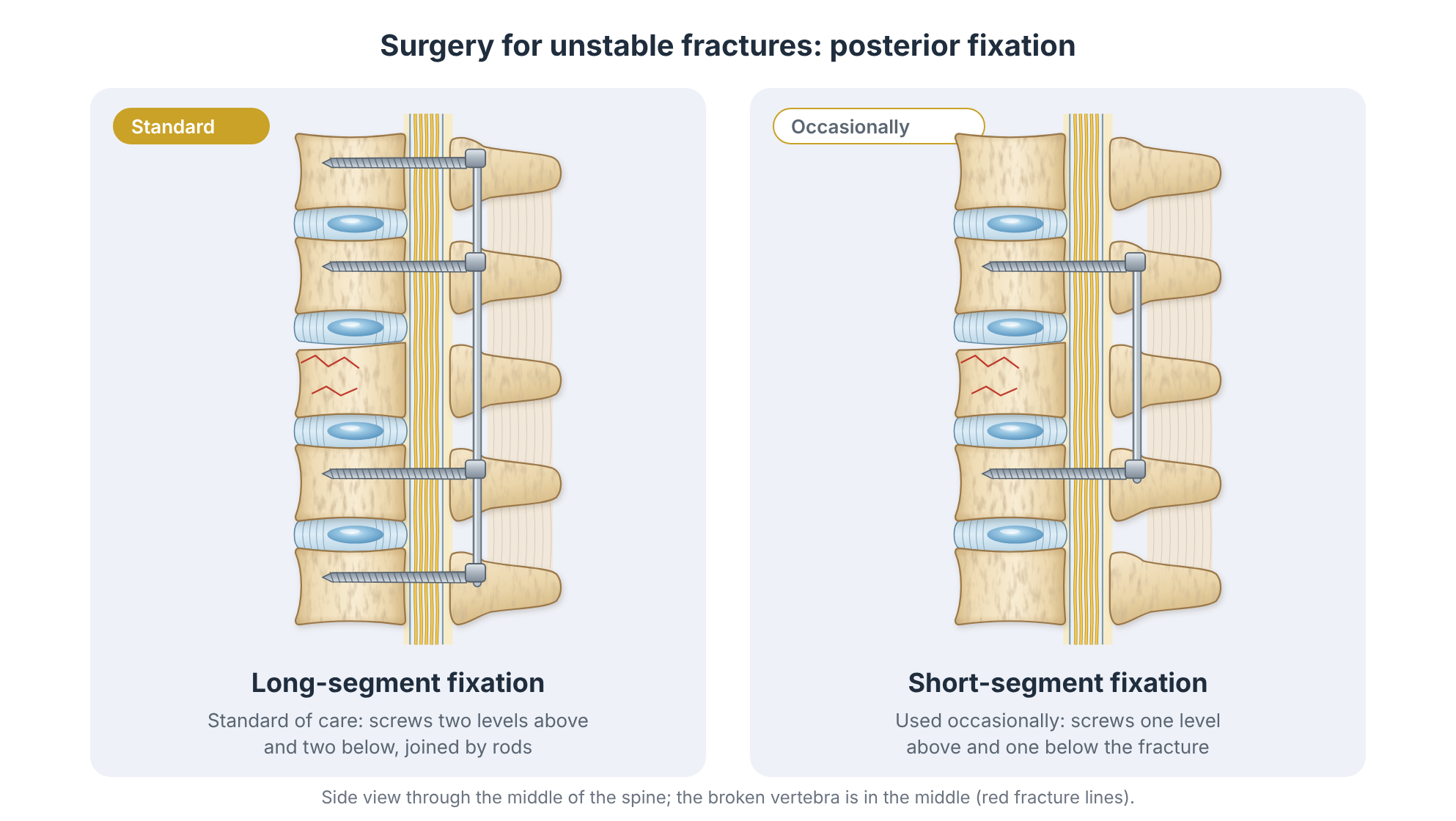 Posterior fixation for an unstable thoracolumbar fracture: long-segment fixation two levels above and below, and short-segment fixation one level above and below