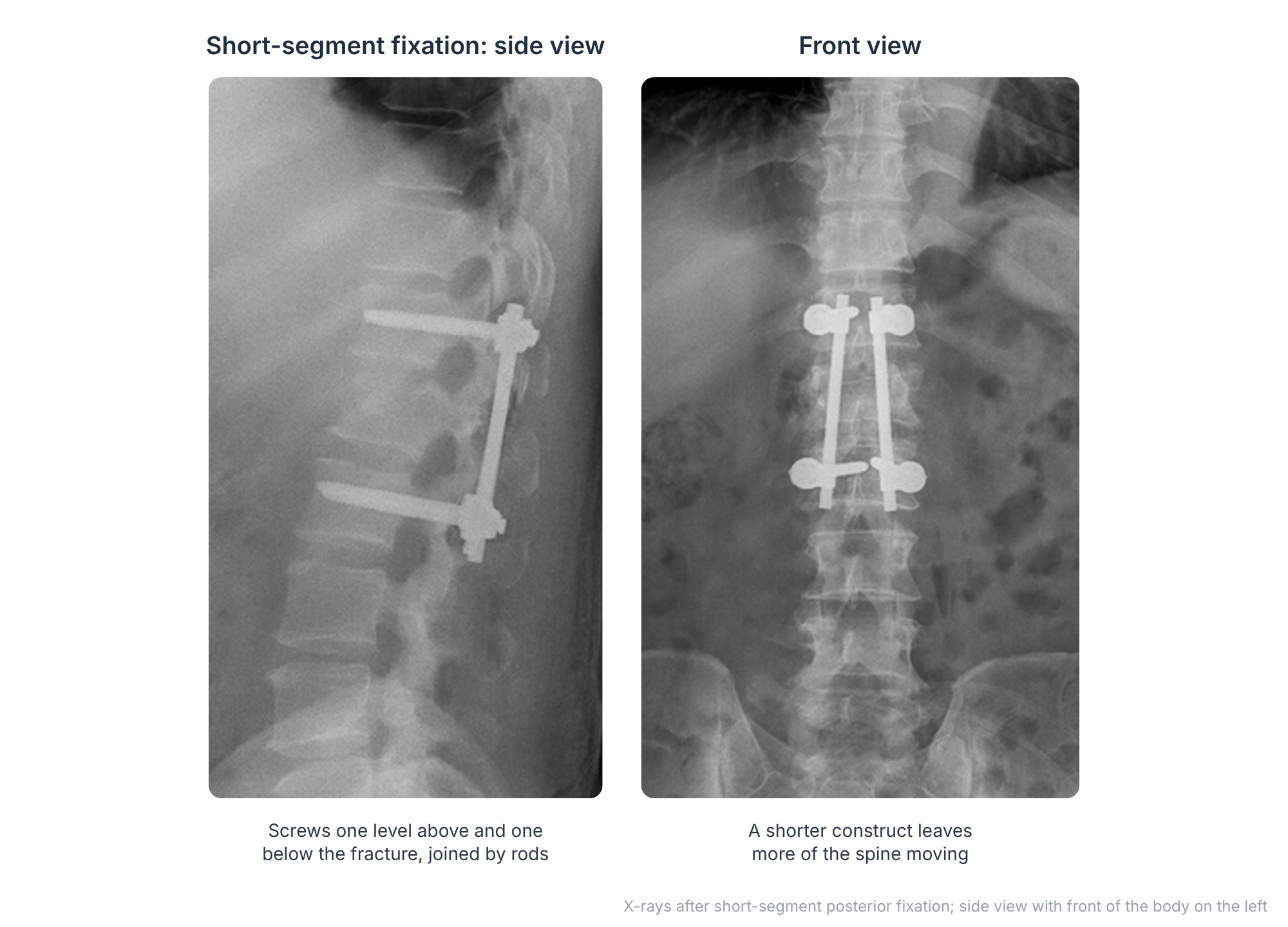 Side and front X-rays after short-segment posterior fixation of a thoracolumbar fracture, with screws one level above and one below