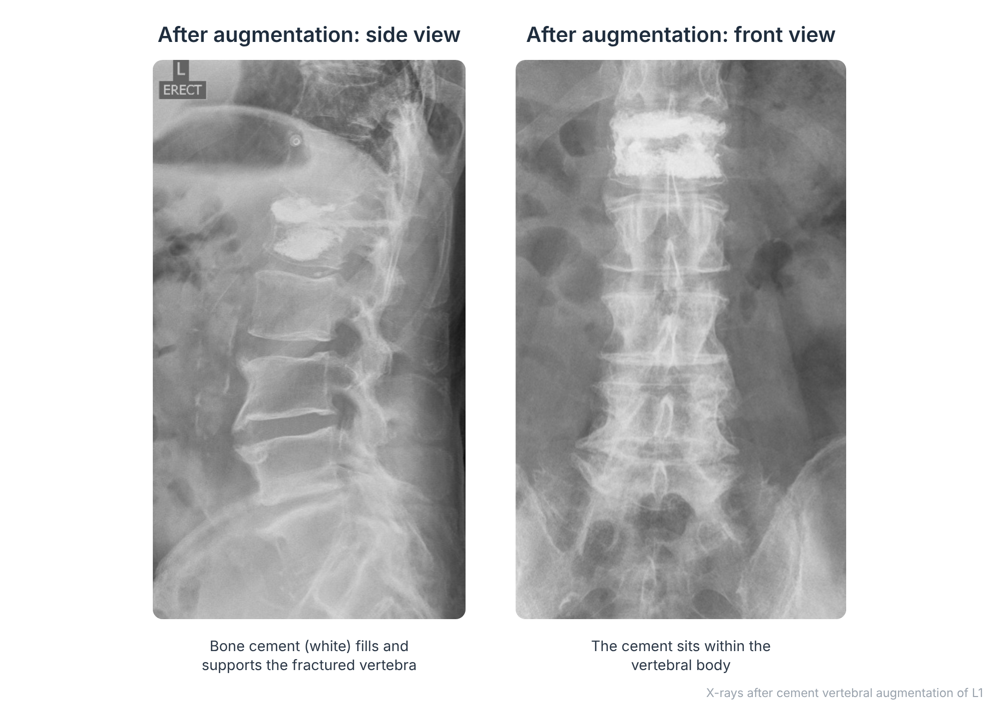 Side and front X-rays after cement vertebral augmentation of the L1 vertebra