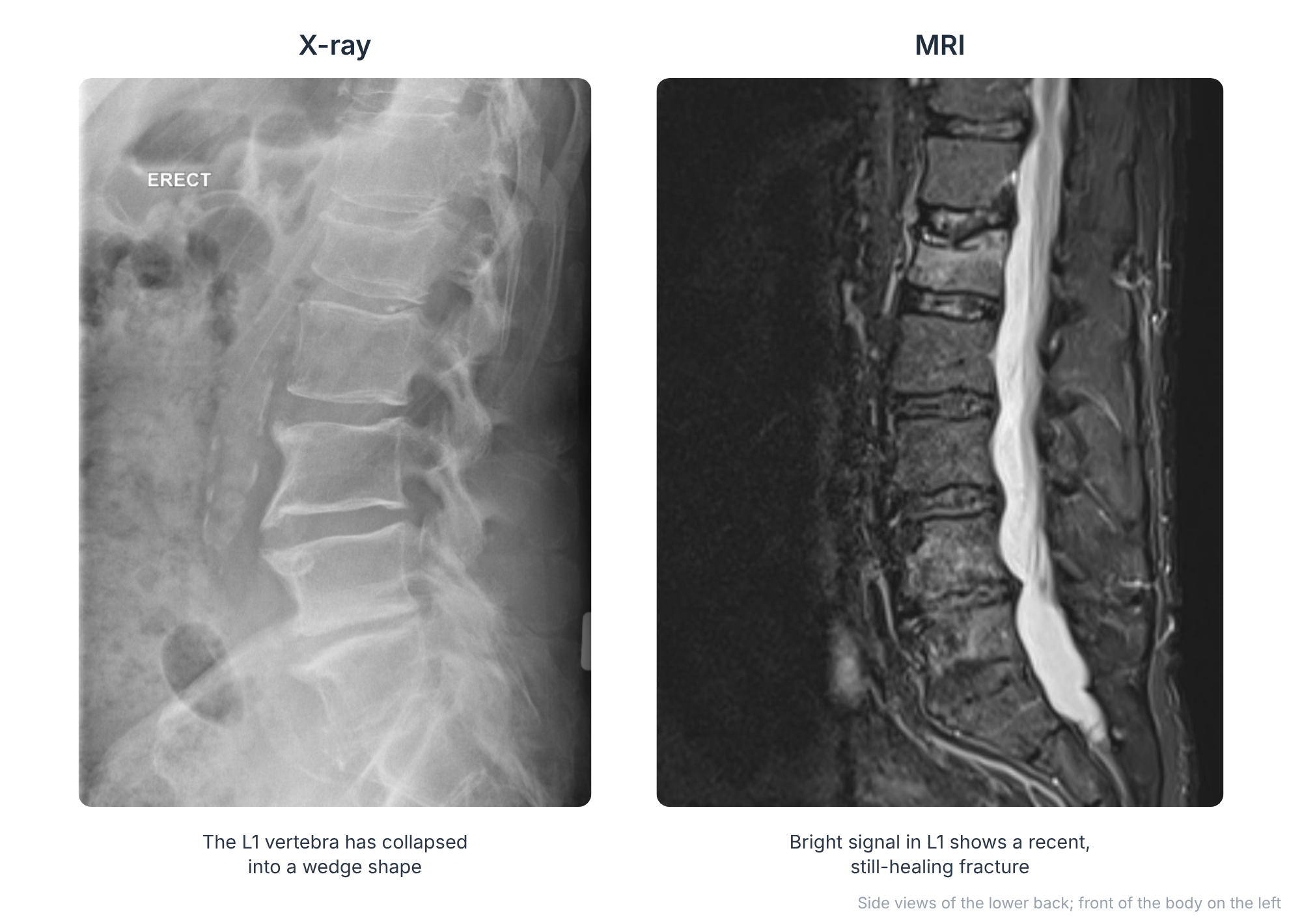 Side X-ray and MRI of the lower back showing a compression fracture of the L1 vertebra